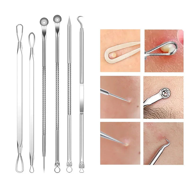 Stainless steel acne and blackhead remover kit showing various tools for skin cleansing