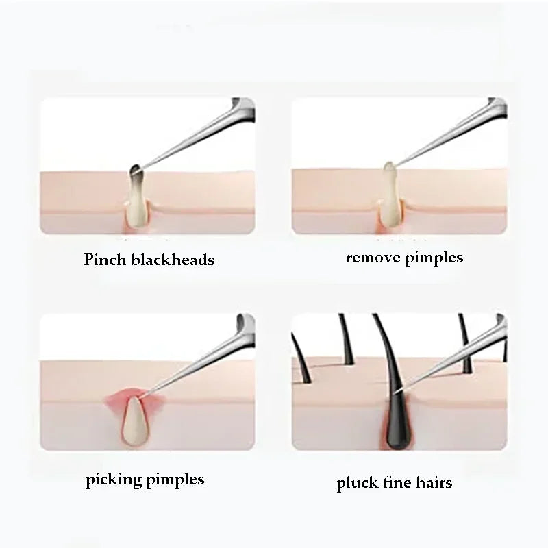 Stainless steel acne and blackhead remover kit showing various tools for removing pimples, blackheads, and fine hairs
