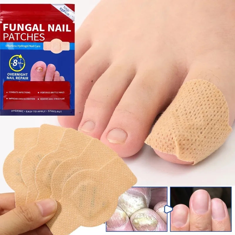 A foot shows a toenail covered with beige fungal nail patches, with a pack of adhesive pads visible below.
